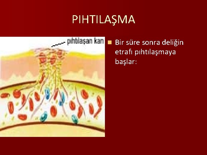 PIHTILAŞMA n Bir süre sonra deliğin etrafı pıhtılaşmaya başlar: 