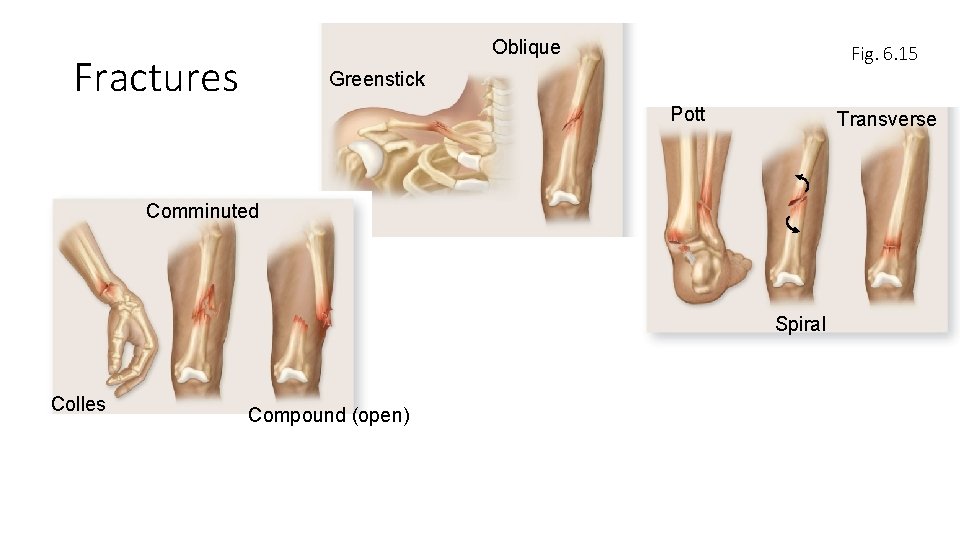 Oblique Fractures Fig. 6. 15 Greenstick Pott Transverse Comminuted Spiral Colles Compound (open) Oblique Fractures Fig. 6. 15 Greenstick Pott Transverse Comminuted Spiral Colles Compound (open)