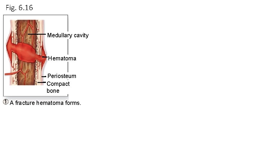 Fig. 6. 16 Medullary cavity Hematoma Periosteum Compact bone 1 A fracture hematoma forms. Fig. 6. 16 Medullary cavity Hematoma Periosteum Compact bone 1 A fracture hematoma forms.