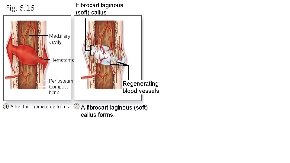 Fibrocartilaginous (soft) callus Fig. 6. 16 Medullary cavity Hematoma Periosteum Compact bone 1 A Fibrocartilaginous (soft) callus Fig. 6. 16 Medullary cavity Hematoma Periosteum Compact bone 1 A