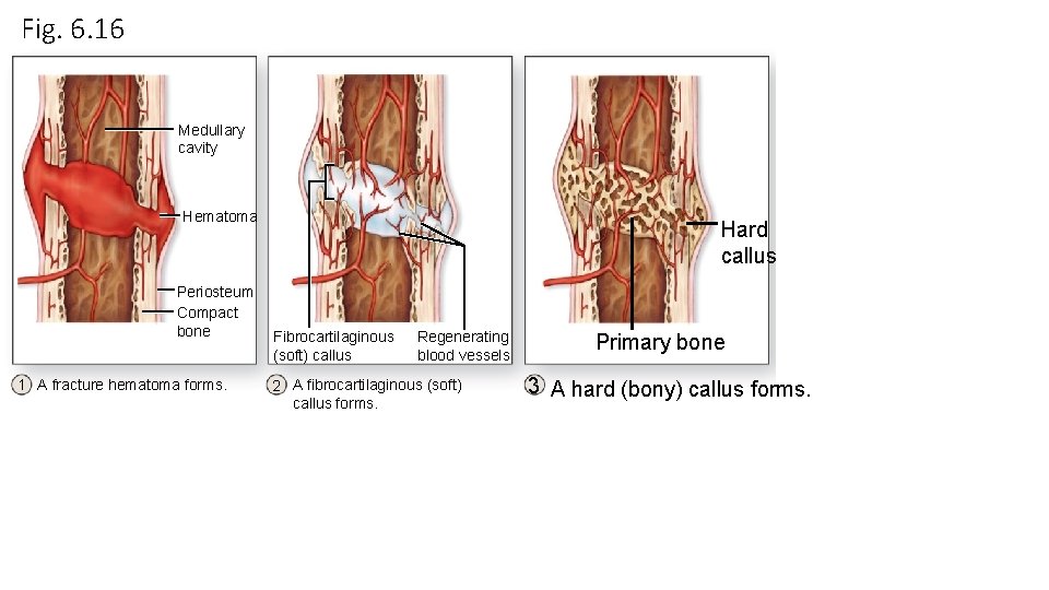 Fig. 6. 16 Medullary cavity Hematoma Periosteum Compact bone 1 A fracture hematoma forms. Fig. 6. 16 Medullary cavity Hematoma Periosteum Compact bone 1 A fracture hematoma forms.