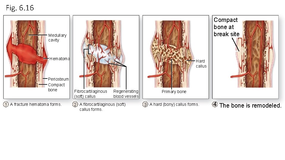 Fig. 6. 16 Compact bone at break site Medullary cavity Hematoma Periosteum Compact bone Fig. 6. 16 Compact bone at break site Medullary cavity Hematoma Periosteum Compact bone
