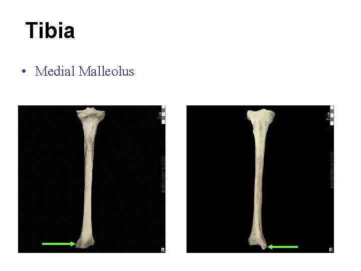 Tibia • Medial Malleolus 