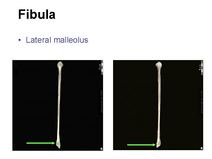 Fibula • Lateral malleolus 