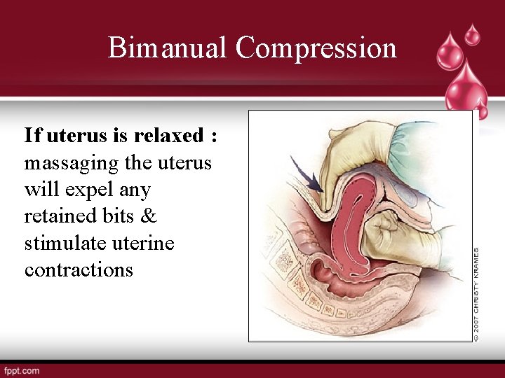 Bimanual Compression If uterus is relaxed : massaging the uterus will expel any retained