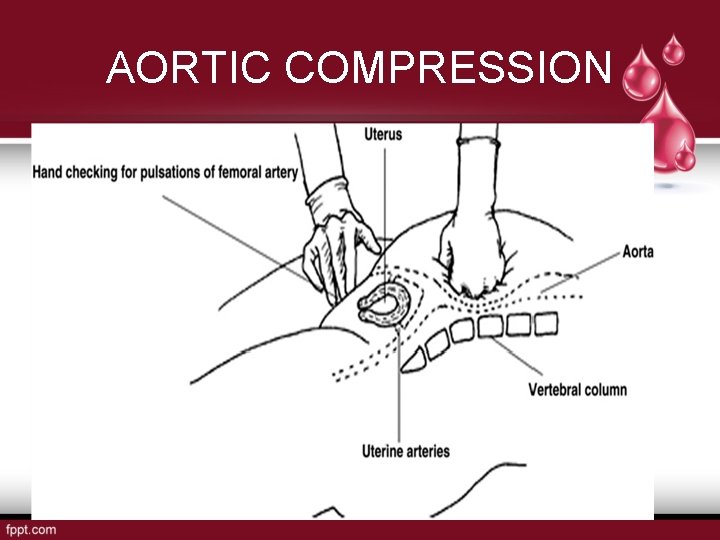 AORTIC COMPRESSION 