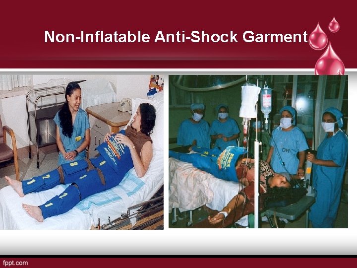 Non-Inflatable Anti-Shock Garment 