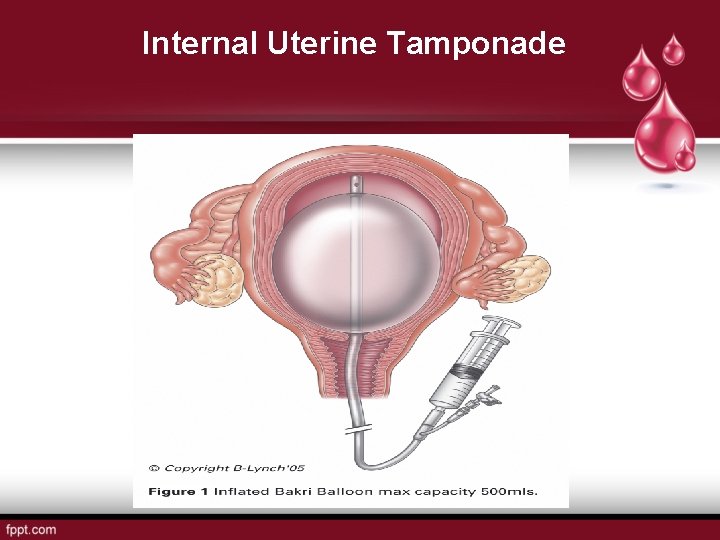 Internal Uterine Tamponade 