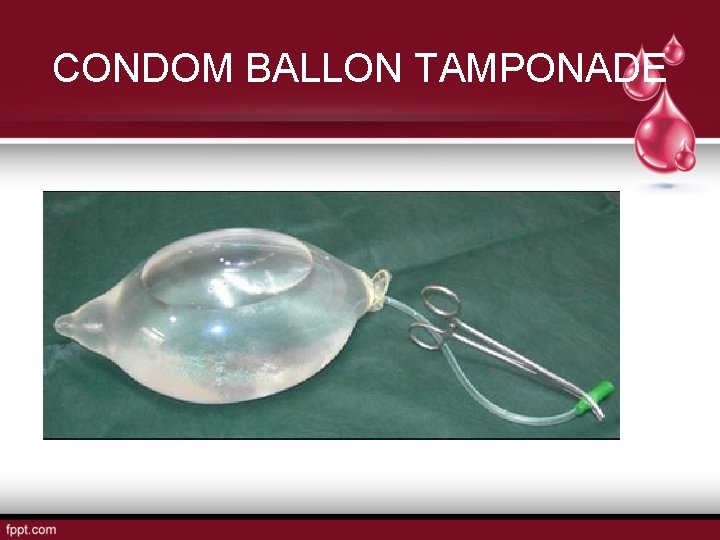 CONDOM BALLON TAMPONADE 