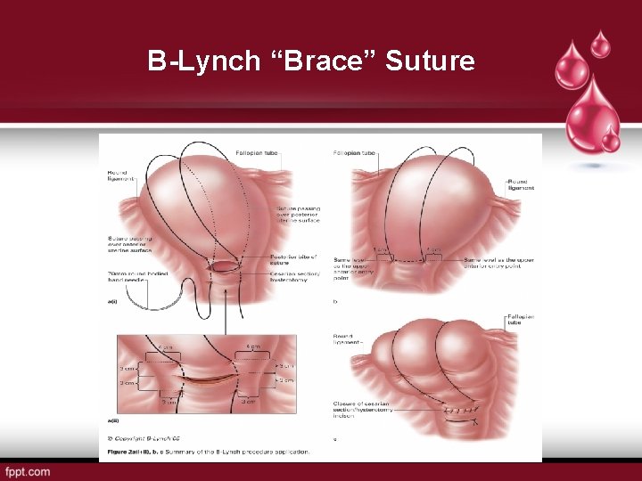 B-Lynch “Brace” Suture 