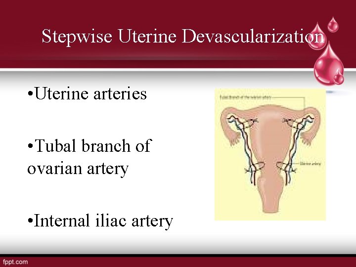 Stepwise Uterine Devascularization • Uterine arteries • Tubal branch of ovarian artery • Internal