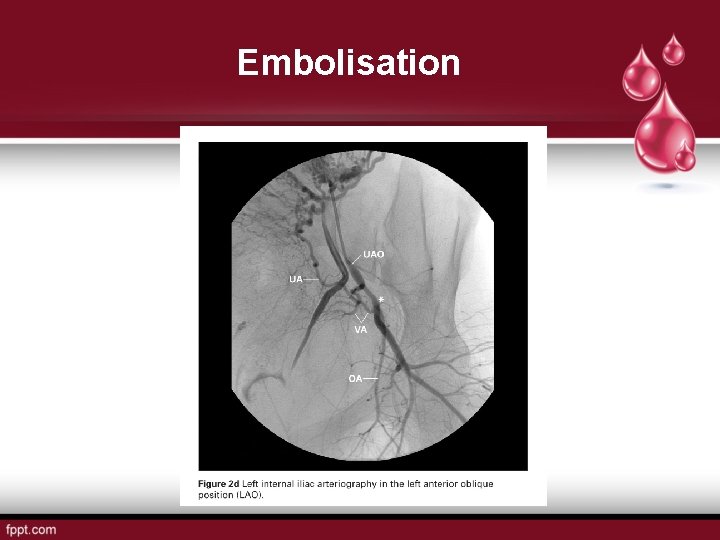 Embolisation 