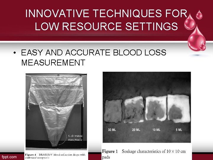 INNOVATIVE TECHNIQUES FOR LOW RESOURCE SETTINGS • EASY AND ACCURATE BLOOD LOSS MEASUREMENT 