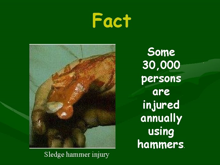 Fact Sledge hammer injury Some 30, 000 persons are injured annually using hammers. 