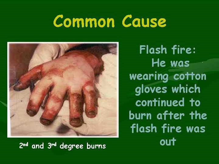 Common Cause 2 nd and 3 rd degree burns Flash fire: He was wearing