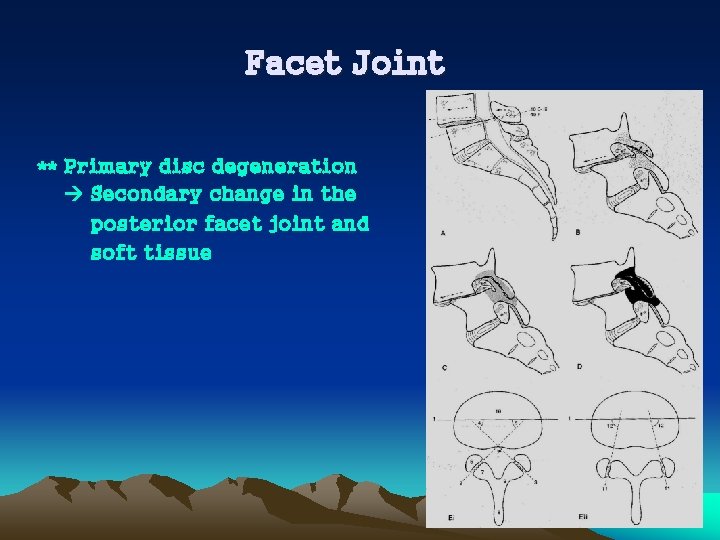 Facet Joint ** Primary disc degeneration Secondary change in the posterior facet joint and