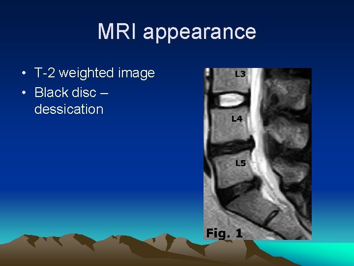 MRI appearance • T-2 weighted image • Black disc – dessication 