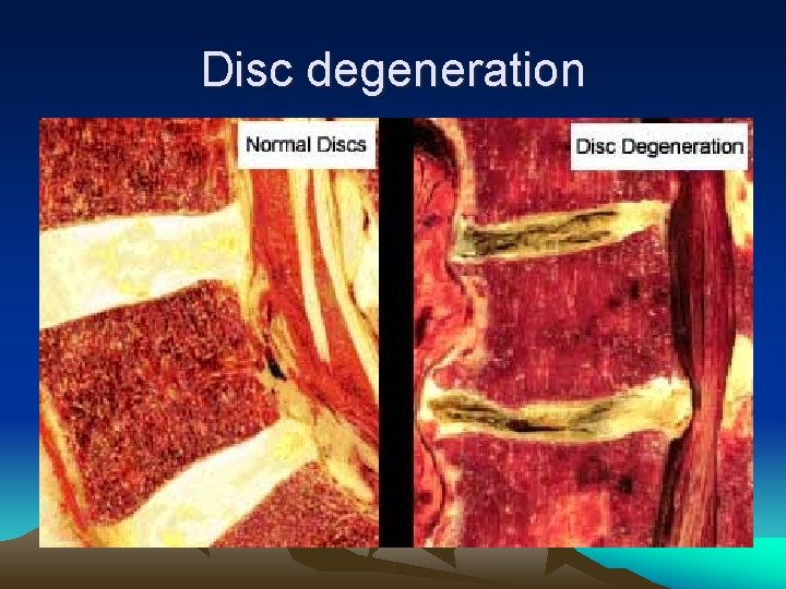 Disc degeneration 