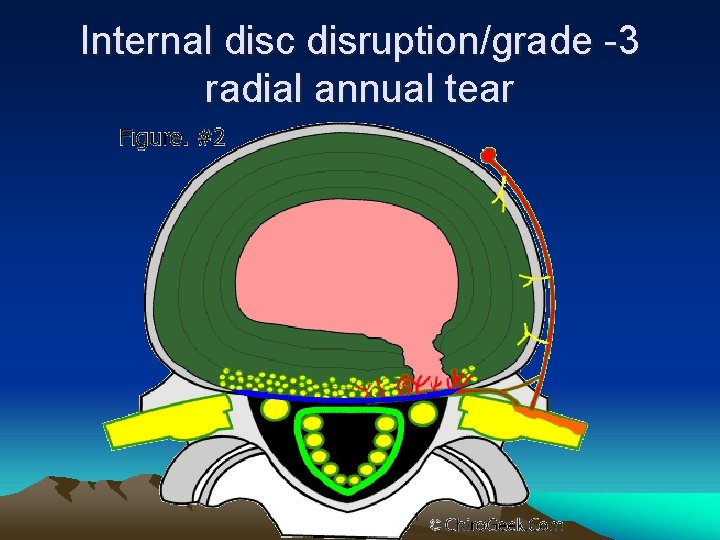 Internal disc disruption/grade -3 radial annual tear 