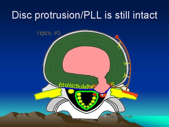Disc protrusion/PLL is still intact 