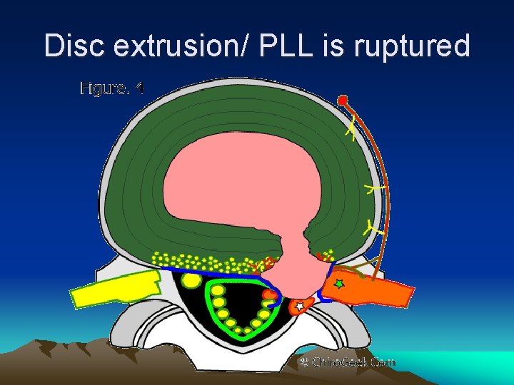 Disc extrusion/ PLL is ruptured 