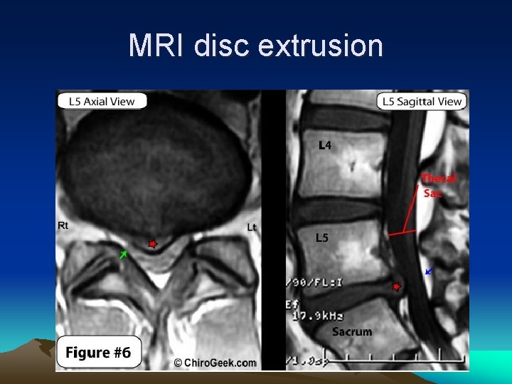 MRI disc extrusion 
