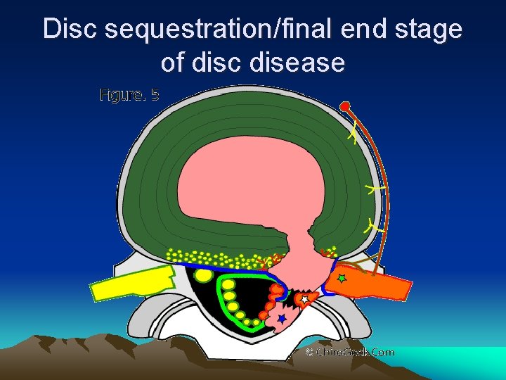 Disc sequestration/final end stage of disc disease 