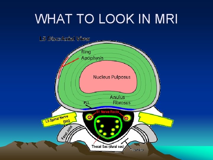 WHAT TO LOOK IN MRI 