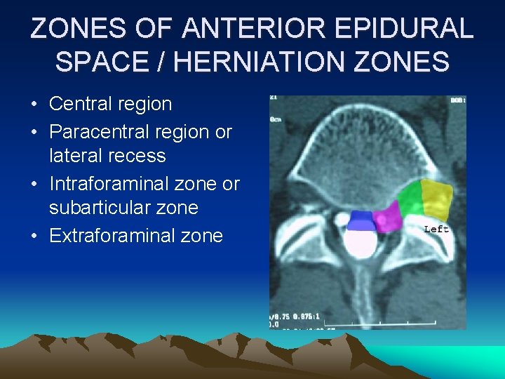 ZONES OF ANTERIOR EPIDURAL SPACE / HERNIATION ZONES • Central region • Paracentral region