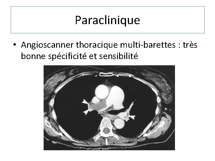 Paraclinique • Angioscanner thoracique multi-barettes : très bonne spécificité et sensibilité 