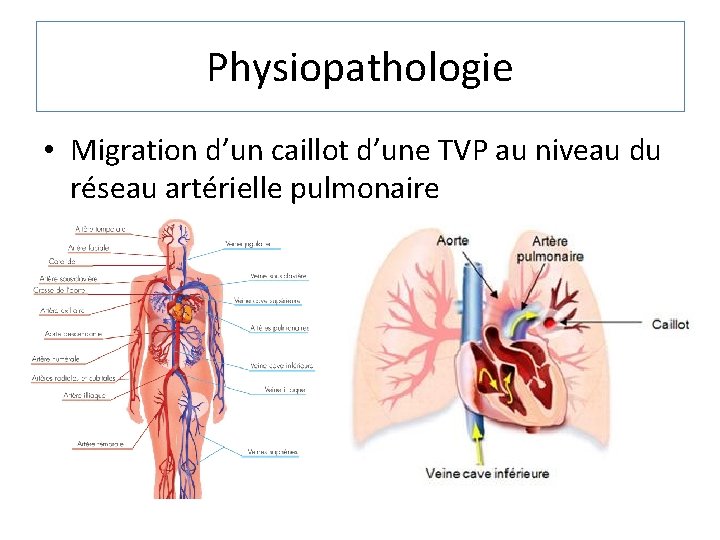 Physiopathologie • Migration d’un caillot d’une TVP au niveau du réseau artérielle pulmonaire 