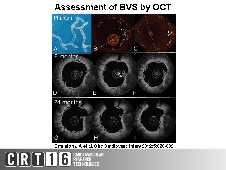 Assessment of BVS by OCT Ormiston J A et al. Circ Cardiovasc Interv 2012;