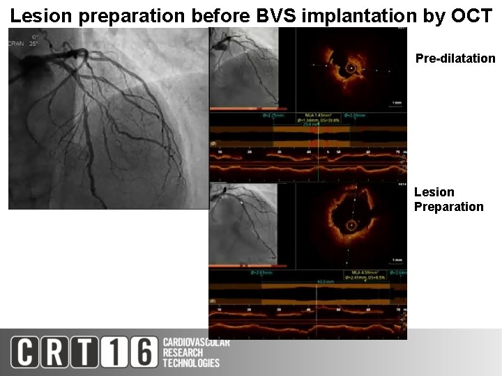 Lesion preparation before BVS implantation by OCT Pre-dilatation Lesion Preparation 