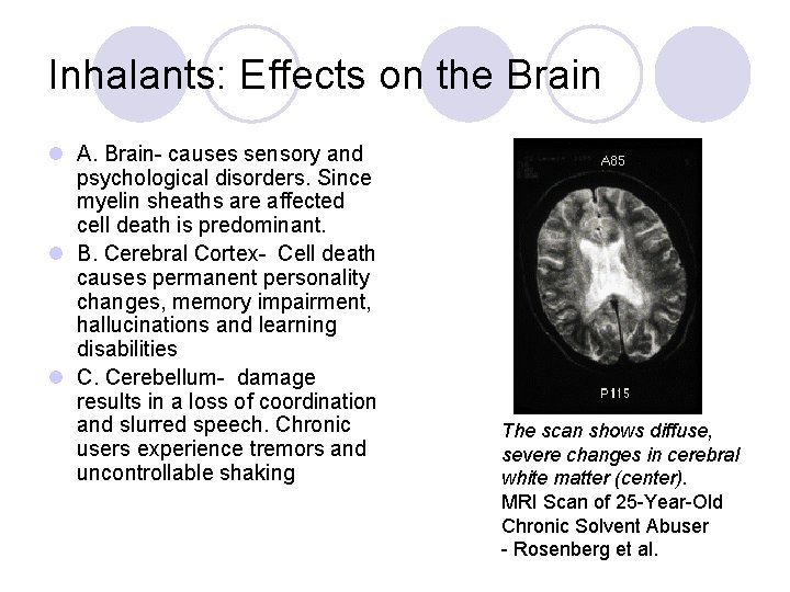 Inhalants: Effects on the Brain l A. Brain- causes sensory and psychological disorders. Since