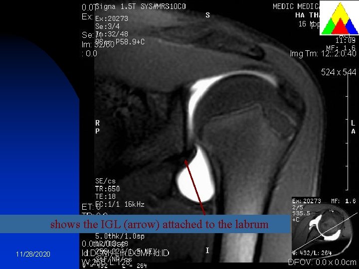 shows the IGL (arrow) attached to the labrum 11/28/2020 18 