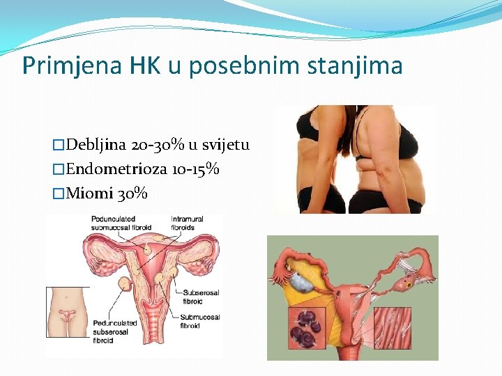 Primjena HK u posebnim stanjima �Debljina 20 -30% u svijetu �Endometrioza 10 -15% �Miomi