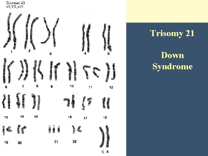 Trisomy 21 Down Syndrome 