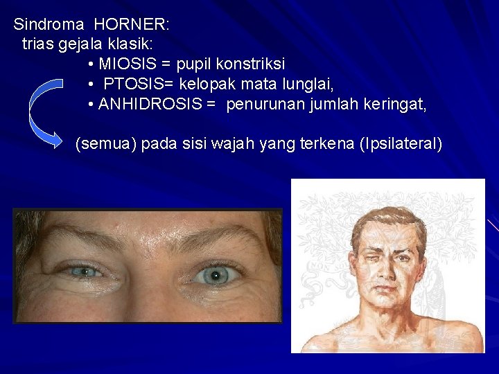 Sindroma HORNER: trias gejala klasik: • MIOSIS = pupil konstriksi • PTOSIS= kelopak mata