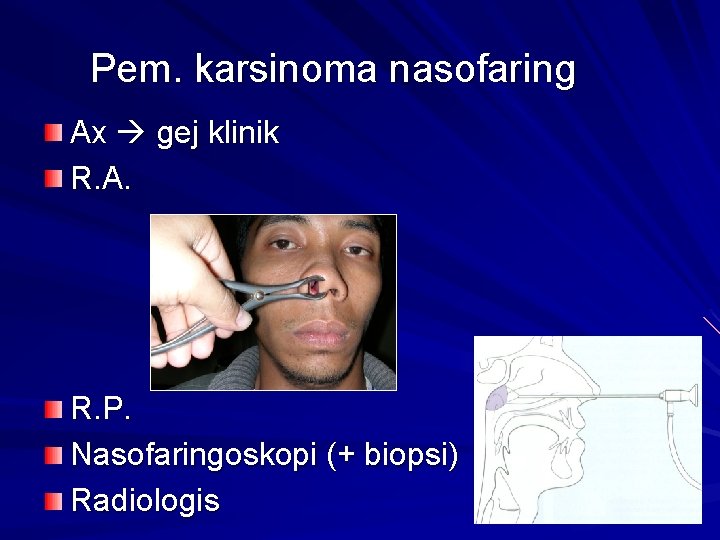 Pem. karsinoma nasofaring Ax gej klinik R. A. R. P. Nasofaringoskopi (+ biopsi) Radiologis