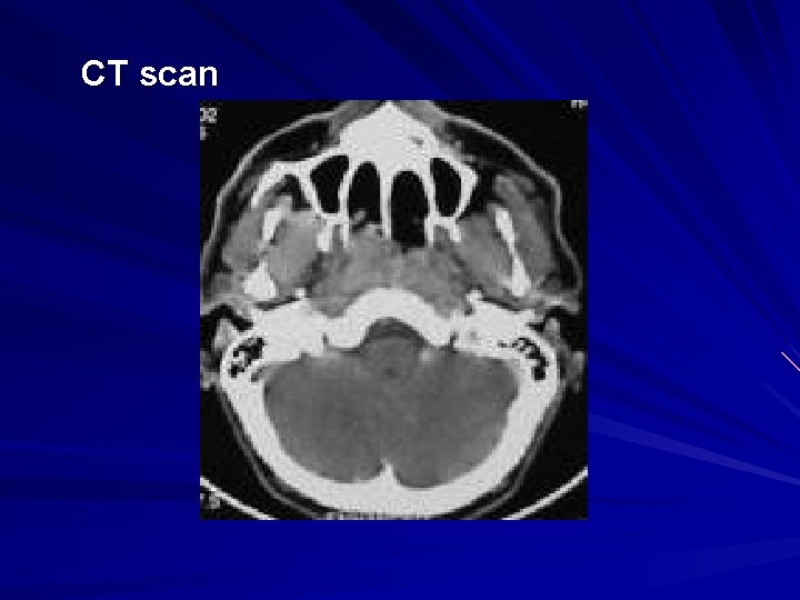 CT scan 