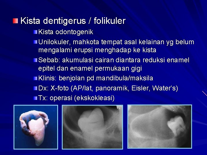 Kista dentigerus / folikuler Kista odontogenik Unilokuler, mahkota tempat asal kelainan yg belum mengalami