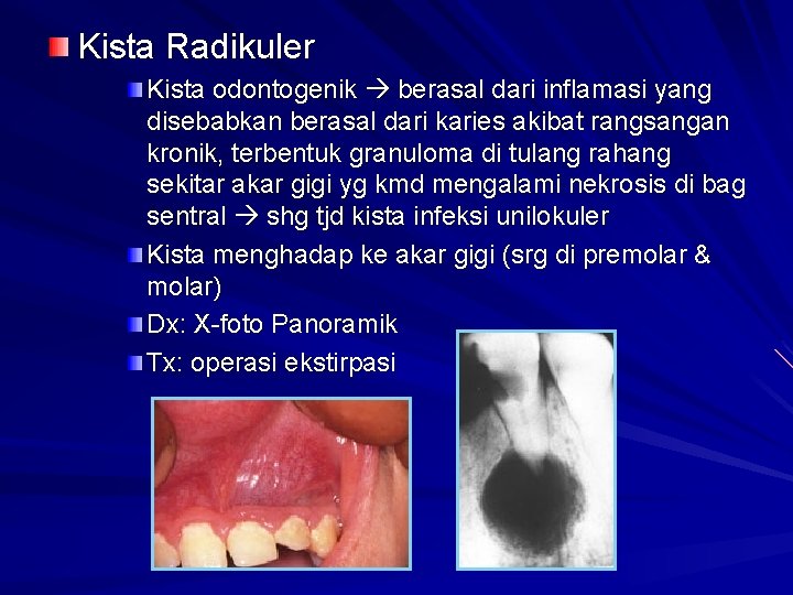 Kista Radikuler Kista odontogenik berasal dari inflamasi yang disebabkan berasal dari karies akibat rangsangan