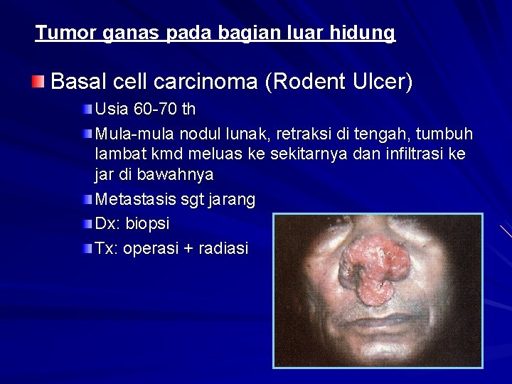 Tumor ganas pada bagian luar hidung Basal cell carcinoma (Rodent Ulcer) Usia 60 70