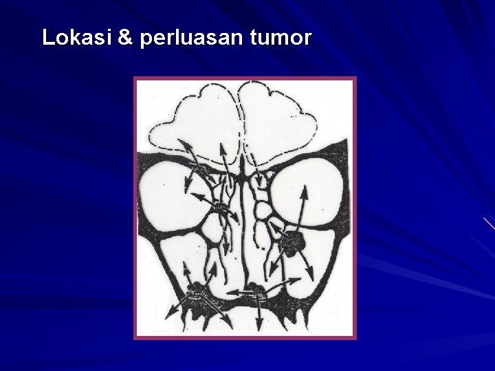 Lokasi & perluasan tumor 