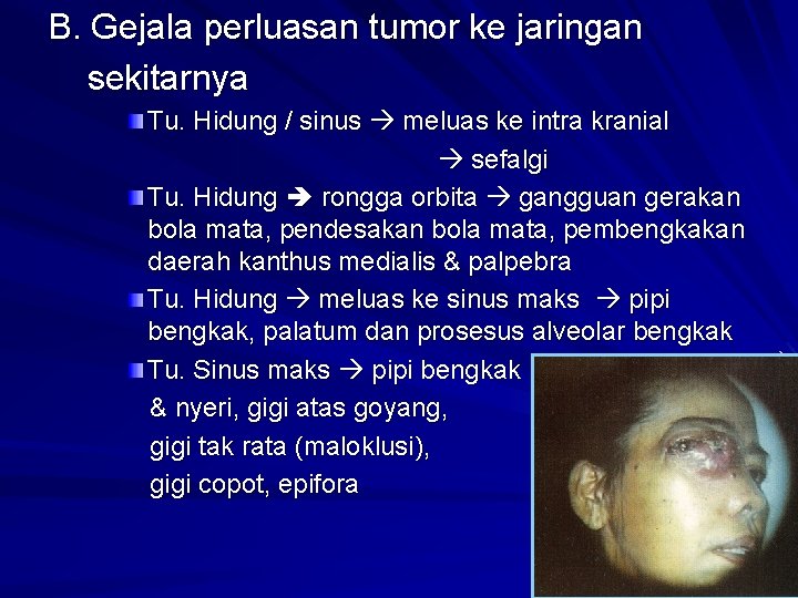 B. Gejala perluasan tumor ke jaringan sekitarnya Tu. Hidung / sinus meluas ke intra