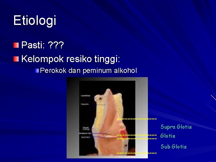 Etiologi Pasti: ? ? ? Kelompok resiko tinggi: Perokok dan peminum alkohol Supra Glotis