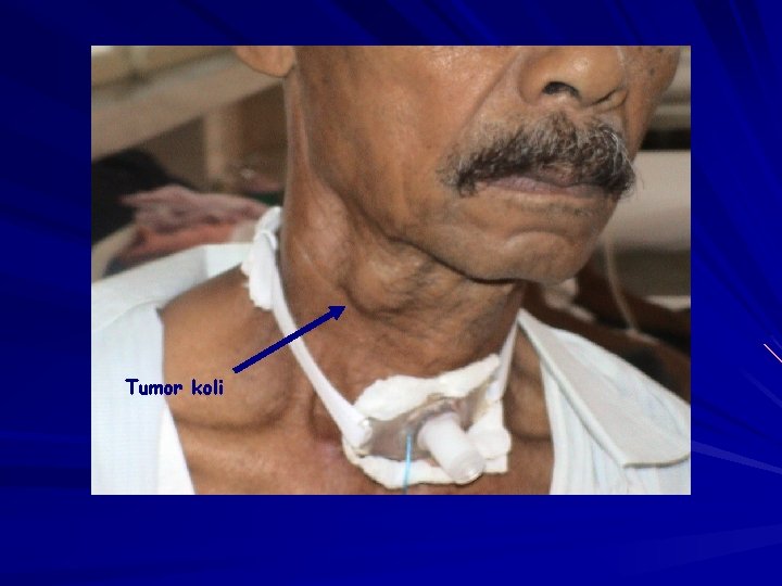 Tumor koli 