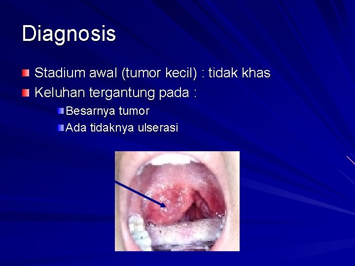 Diagnosis Stadium awal (tumor kecil) : tidak khas Keluhan tergantung pada : Besarnya tumor