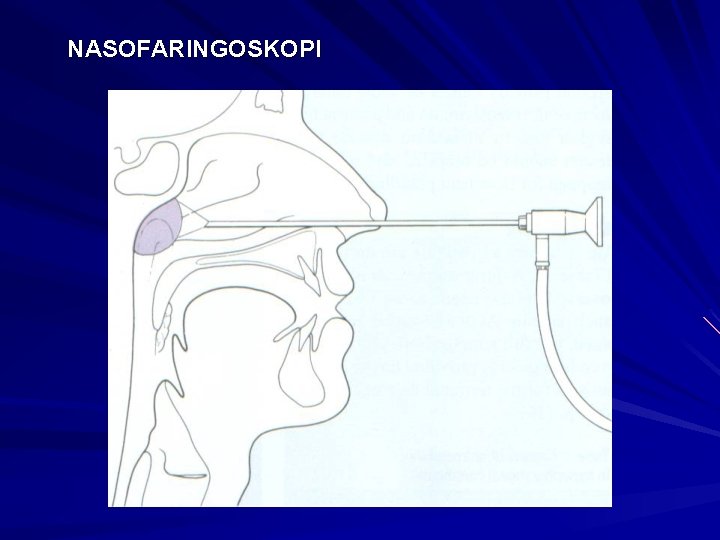 NASOFARINGOSKOPI 