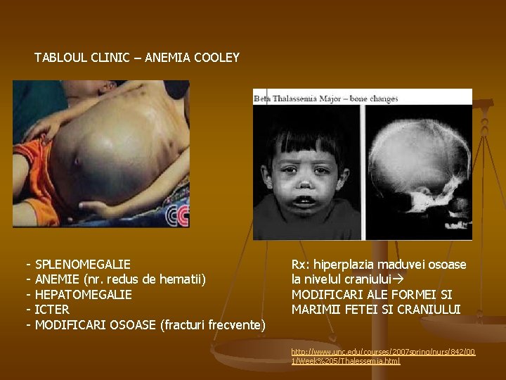TABLOUL CLINIC – ANEMIA COOLEY - SPLENOMEGALIE ANEMIE (nr. redus de hematii) HEPATOMEGALIE ICTER